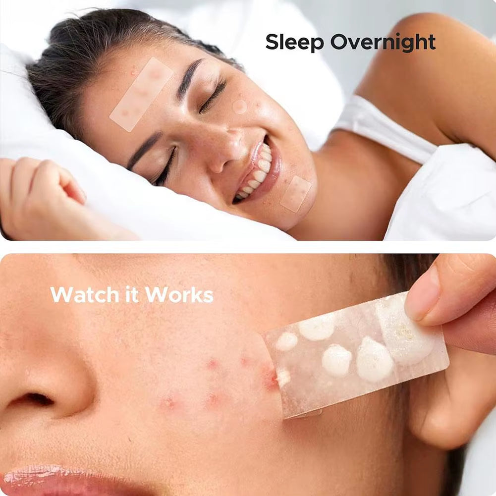 Mixed Sizes Hydrocolloid Pimple Patches Large Hydrocolloid Pimple Patches Invisible Acne Circle Stickers for Zits, Spots, Pimple